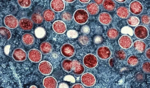 Mpox: OMS volta a declarar doença como ‘emergência’ global em saúde pública