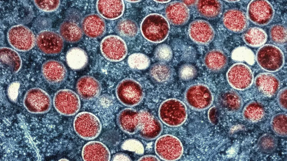 Mpox: conheça os sintomas e tire as principais dúvidas sobre a doença