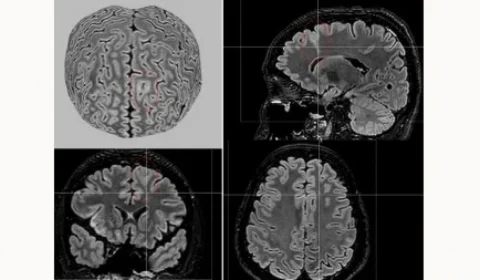 IA detecta lesões cerebrais invisíveis em pacientes com epilepsia