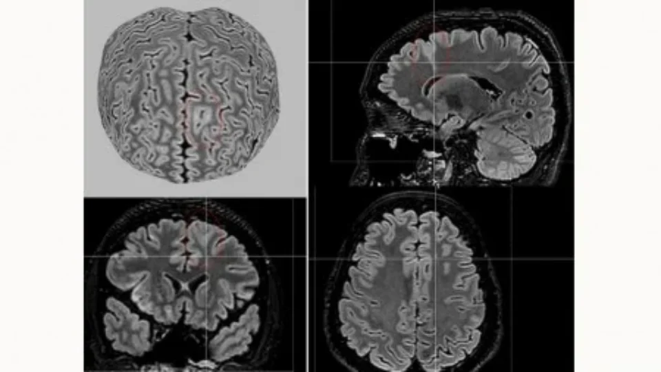 IA detecta lesões cerebrais invisíveis em pacientes com epilepsia
