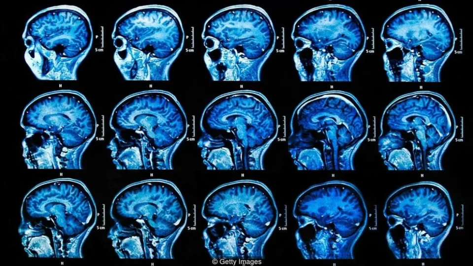 Medicamento que retarda o Alzheimer pode chegar ao Brasil ainda este ano