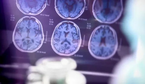 Aprovação de remédio para Alzheimer no Brasil é marco regulatório importante