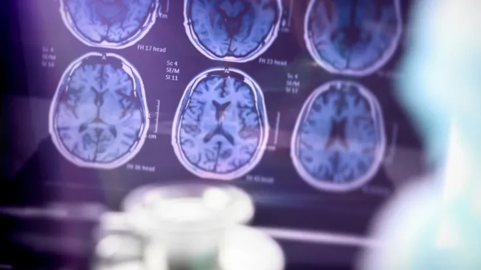 Anvisa aprova primeiro medicamento para tratar doença de Alzheimer