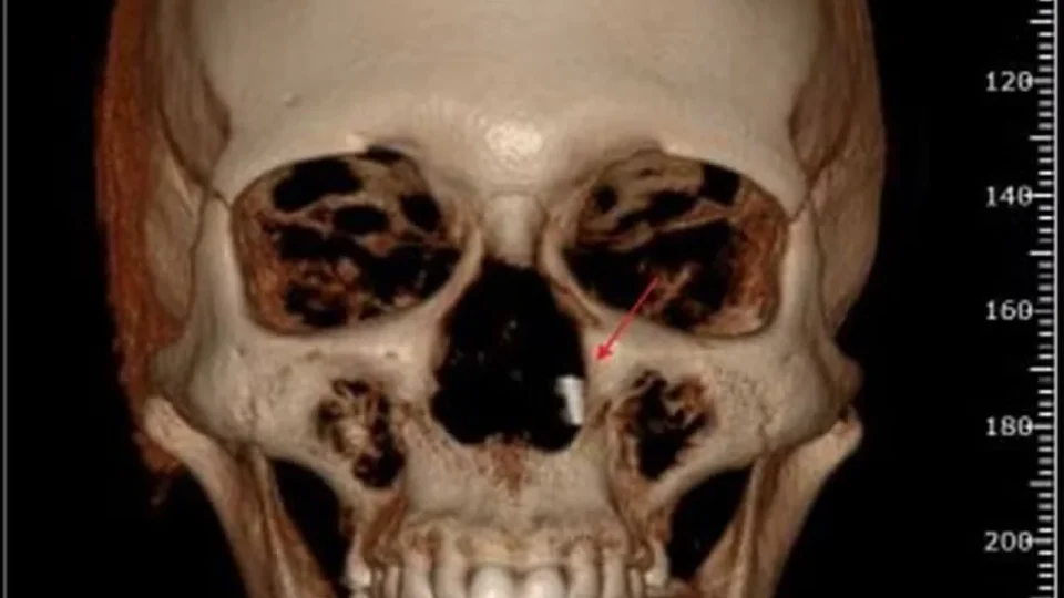 Dentistas são condenados após broca cirúrgica ficar alojada no crânio de paciente