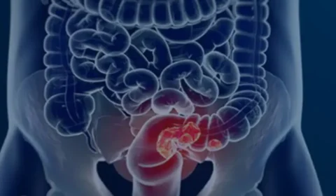 Conheça o alimento que reduz em 20% o risco de câncer de intestino, segundo novo estudo