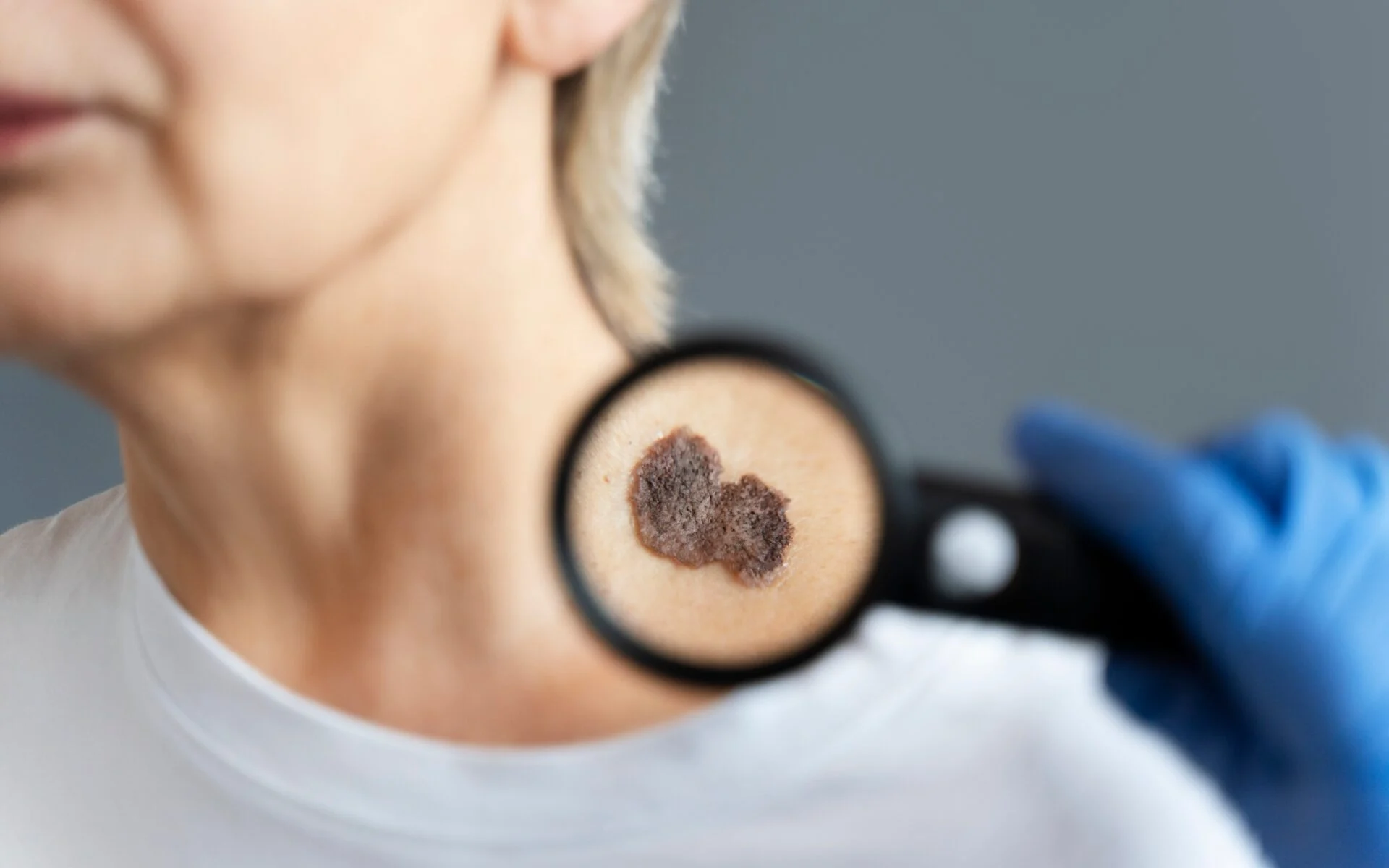 Tumor maligno mais incidente no Brasil - o de pele não melanoma