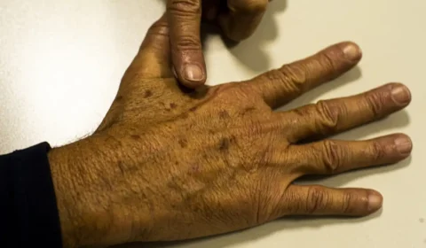 Tumor maligno mais incidente no Brasil – o de pele não melanoma
