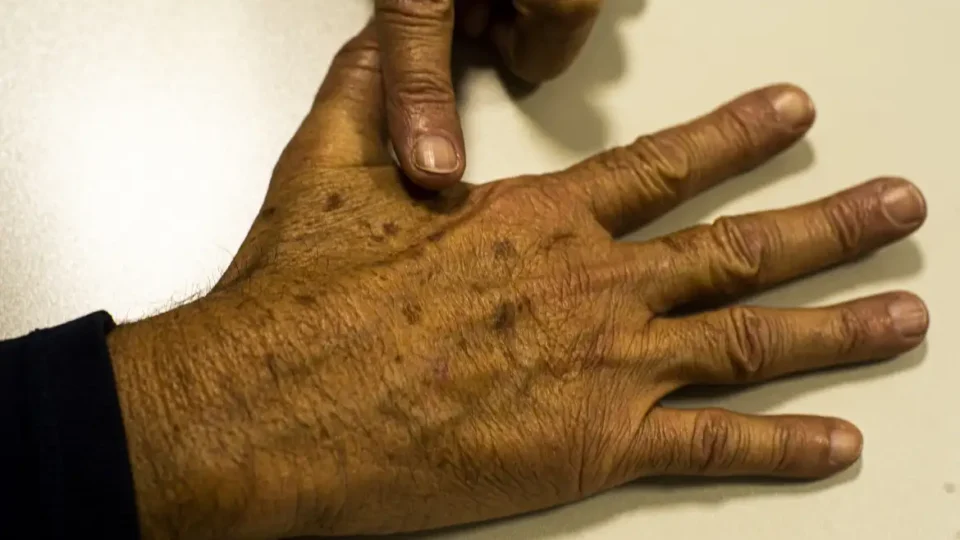Tumor maligno mais incidente no Brasil – o de pele não melanoma
