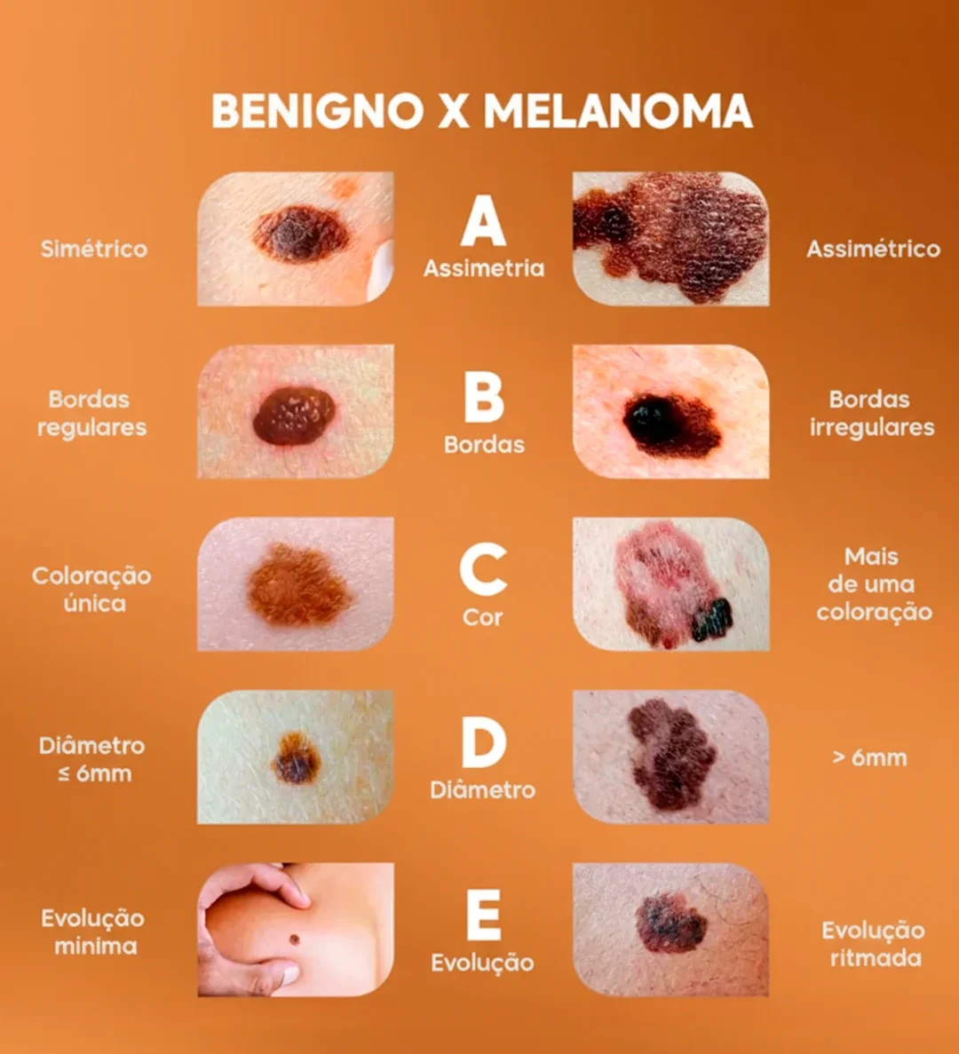 “A exposição solar repetida é a principal causa do câncer de pele”, diz Dr. Drauzio Varella