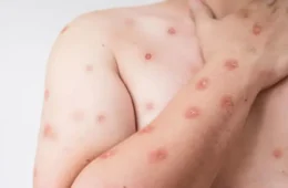 Brasil registra 48 casos de mpox nos primeiros meses de 2026