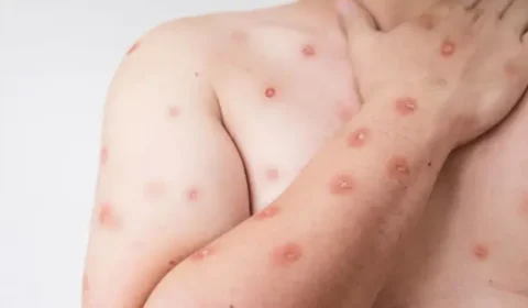 Brasil registra 48 casos de mpox nos primeiros meses de 2026