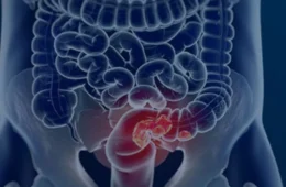Veja seis sintomas que podem sinalizar o câncer de intestino em estágio inicial