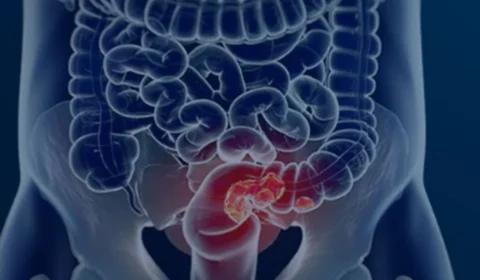 Veja seis sintomas que podem sinalizar o câncer de intestino em estágio inicial