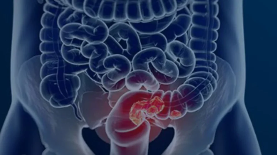 Veja seis sintomas que podem sinalizar o câncer de intestino em estágio inicial