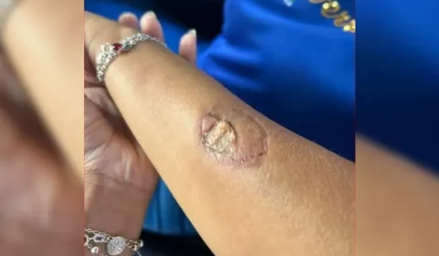 Mãe de aluno agride funcionárias e morde vice-diretora em escola no PR