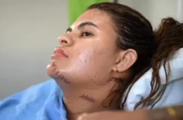 ‘Me fiz de morta’, diz mulher que teve mãos amputadas em ataque com foice no Ceará
