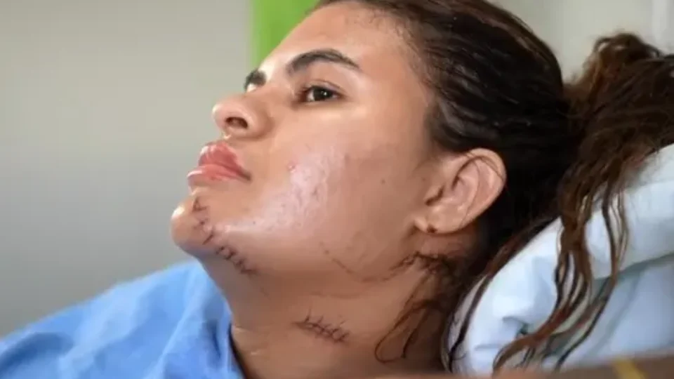 ‘Me fiz de morta’, diz mulher que teve mãos amputadas em ataque com foice no Ceará