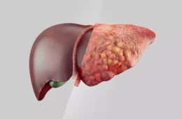 Gordura no fígado: veja os alimentos recomendados e os que devem ser evitados