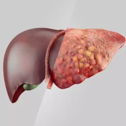 Gordura no fígado: veja os alimentos recomendados e os que devem ser evitados