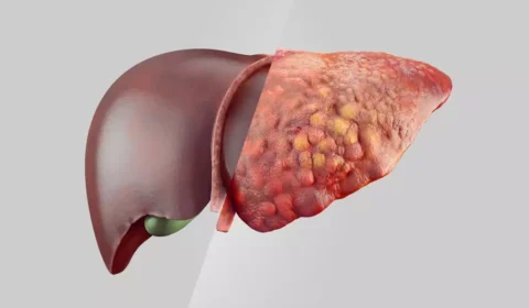 Gordura no fígado: veja os alimentos recomendados e os que devem ser evitados