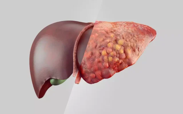 Gordura no fígado: veja os alimentos recomendados e os que devem ser evitados