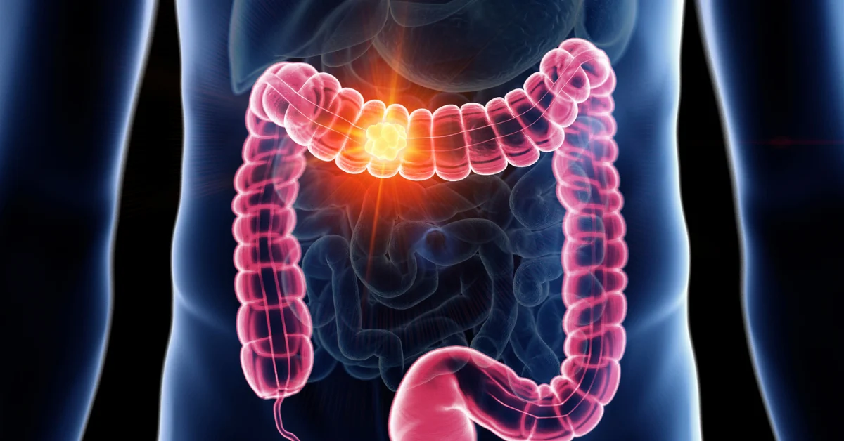 Diagnóstico precoce pode curar 90% dos casos de câncer de intestino