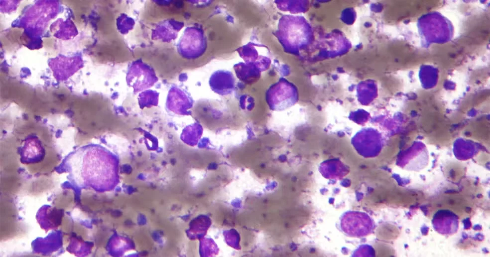 Linfoma não Hodgkin de células B, tipo de câncer agressivo — Foto: Nephron/Wikimedia Commons/CC BY-SA