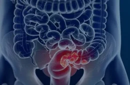 Diagnóstico precoce pode curar 90% dos casos de câncer de intestino; veja os sinais