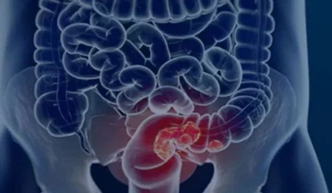 Diagnóstico precoce pode curar 90% dos casos de câncer de intestino; veja os sinais