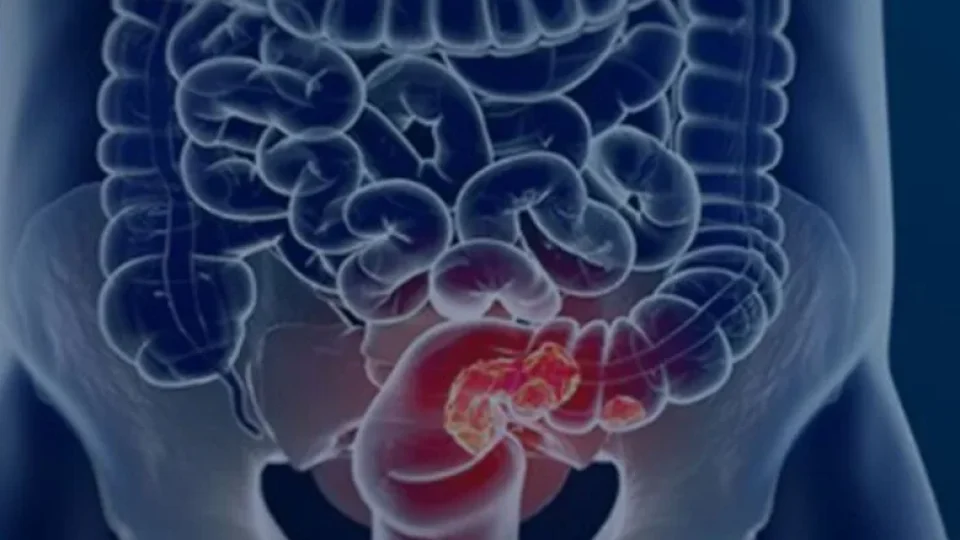 Diagnóstico precoce pode curar 90% dos casos de câncer de intestino; veja os sinais