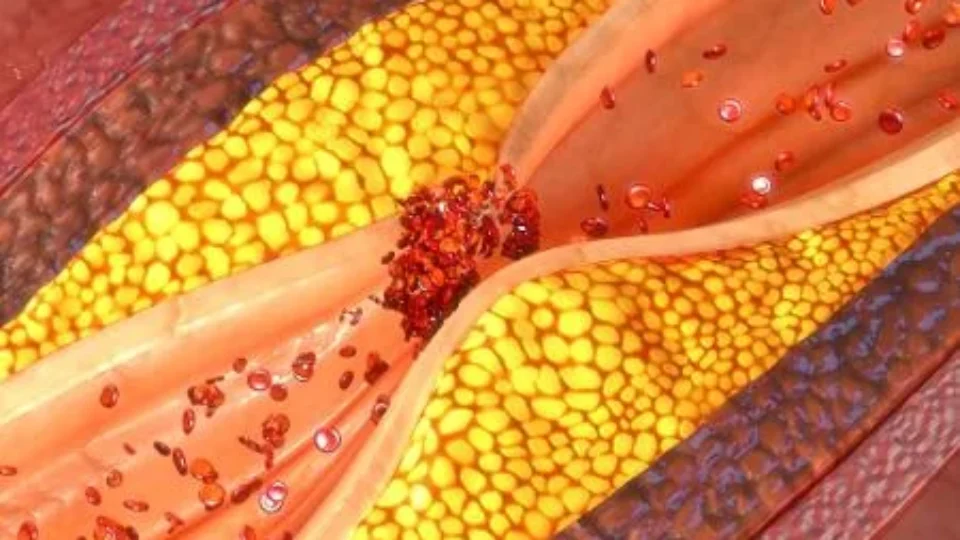 Veja quais alimentos podem ajudar a evitar o entupimento de veias e artérias