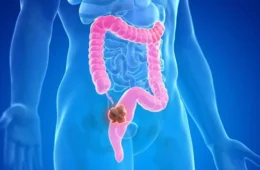 Alimento comum pode reduzir risco de câncer de intestino em até 20%; saiba qual