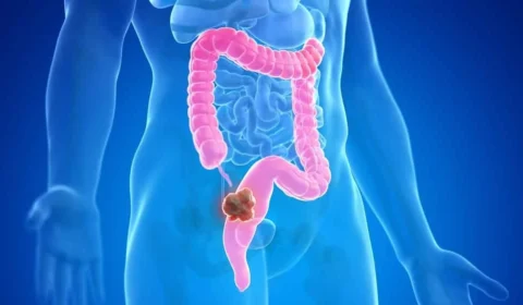 Alimento comum pode reduzir risco de câncer de intestino em até 20%; saiba qual