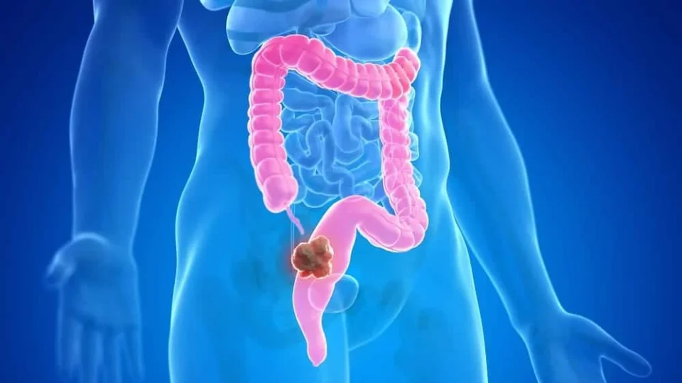 Alimento comum pode reduzir risco de câncer de intestino em até 20%; saiba qual