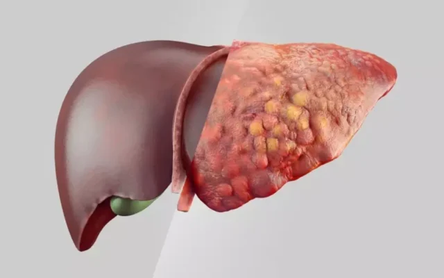 Gordura no fígado: veja seis bebidas e hábitos que ajudam a cuidar do órgão