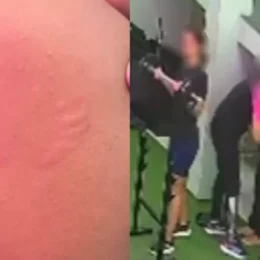 Mulher denuncia assédio após ser mordida por instrutor em academia no Recife