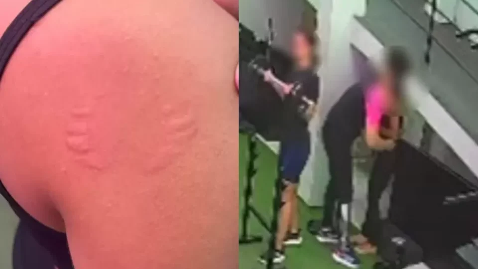 Mulher denuncia assédio após ser mordida por instrutor em academia no Recife