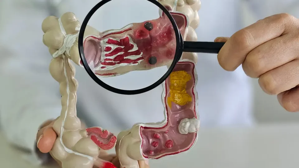 Em 13 anos, doença inflamatória intestinal cresce 5 vezes no Brasil