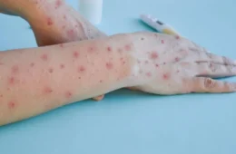 Nova variante do mpox desafia contenção global e exige resposta coletiva