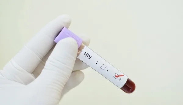 HIV