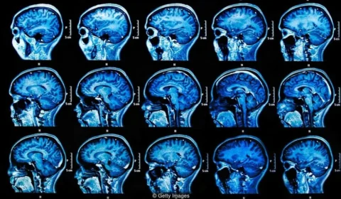 Medicamento que retarda o Alzheimer pode chegar ao Brasil ainda este ano