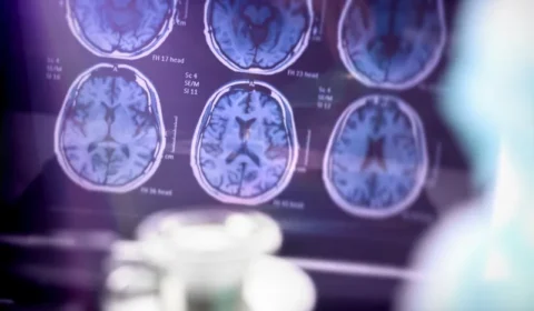 Anvisa aprova primeiro medicamento para tratar doença de Alzheimer